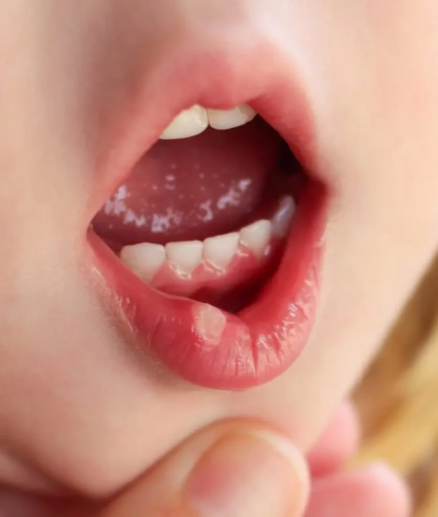 aftosi orale nei bambini michelangelo13 napoli