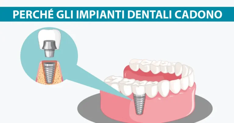 perché gli impianti dentali cadono michelangelo13