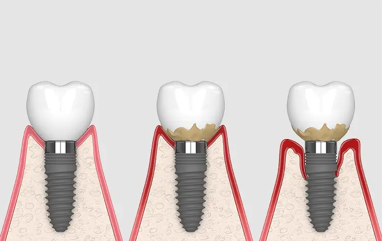 perimplantite caduta impianti