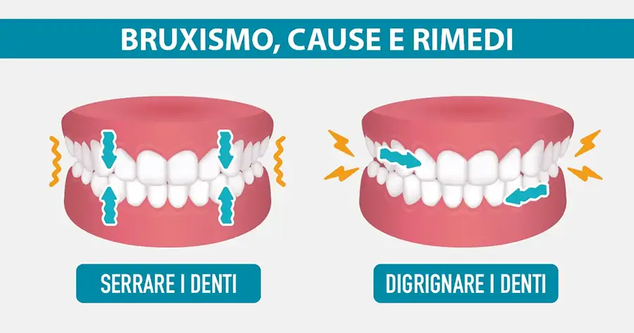 bruxismo cause e rimedi dentista vomero michelangelo13